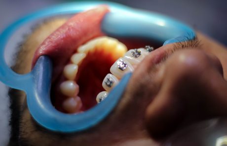 מהן קשתיות שקופות ליישור שיניים?